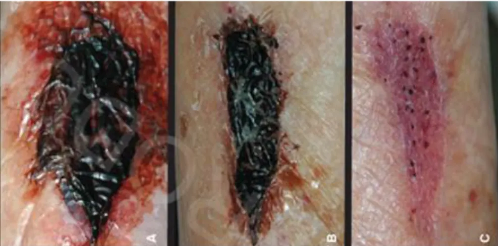 Figura 9 – Evolução processo cicatrização da pele com a apliacação de um curativo de um  biomaterial baseado em CB