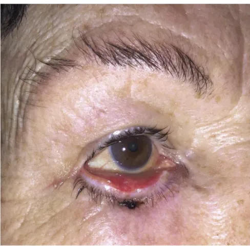 Figure 2. Cicatricial ectropion caused by an excision of basal cell carcinoma of the  lower eyelid