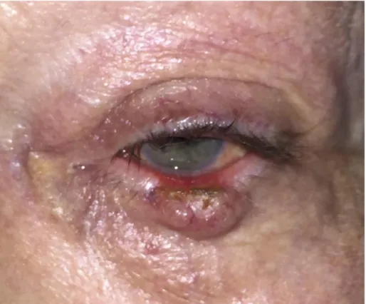 Figure 5. Mechanical ectropion caused by a basal cell carcinoma. 