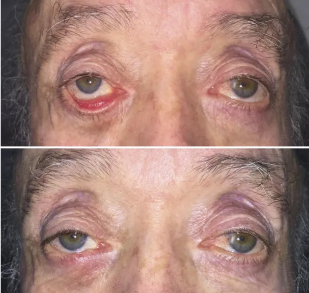 Figure 6. Lacrimal ectropion of the right lower eyelid (top) corrected with a Lazy-T  procedure (bottom)