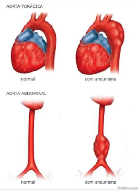 Figura  1.3  -  Representação  esquemática  da  artéria  Aorta  Abdominal  com e sem aneurisma [4]