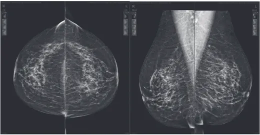 Figura 2 – Imagens de mamografia (incidências básicas de rotina – CCD, CCL, OMLD e OMLE)
