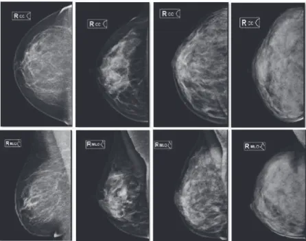 Figura 3 – Exemplos de imagens mamográficas com diferentes densidades radiológicas,  incidências CCD e OMLD, da esquerda para a direita, tipo I, II, III e IV
