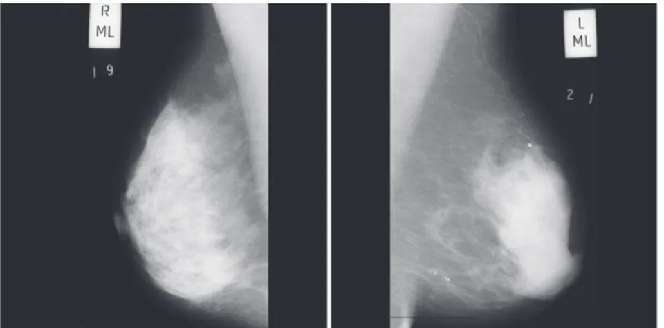 Figura 6 – Exemplos de imagens de mamografia extraídas da base de dados MIAS – Incidência  OMLD e OMLE, ambas consideradas normais