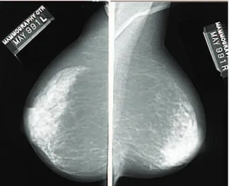 Figura 7 - Exemplos de imagens de mamografia extraídas da base de dados DDSM – Incidência  CCD e OMLE, ambas consideradas normais