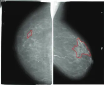 Figura 8 – Exemplos de imagens de mamografia extraídas da base de dados BCDR-FM -  Incidências CCD e MLOE, ambas com lesões malignas com segmentação da área da lesão