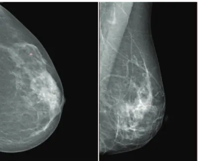 Figura 9 – Exemplos de imagens de mamografia extraídas da base de dados BCDR-DM –  Incidências CCE e OMLE, ambas benignas