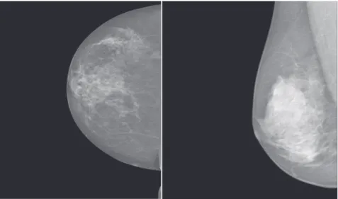 Figura 10 – Exemplos de imagens de mamografia extraídas da base de dados INBreast - -Incidências CCD e OMLD, ambas benignas