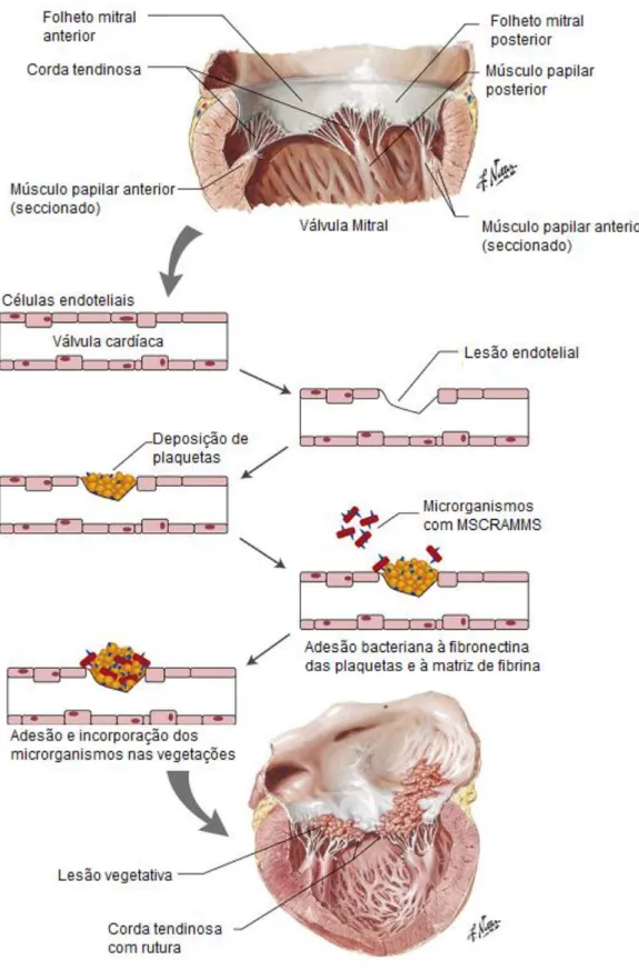 Figura 3 – Patogenia da Endocardite Infeciosa. O desenvolvimento de Endocardite Infeciosa é  desencadeado  por  uma  lesão  endotelial,  seguido  por  deposição  de  fibrina  e  plaquetas  que  funcionam  como  substracto  para  a  colonização  e  adesão  