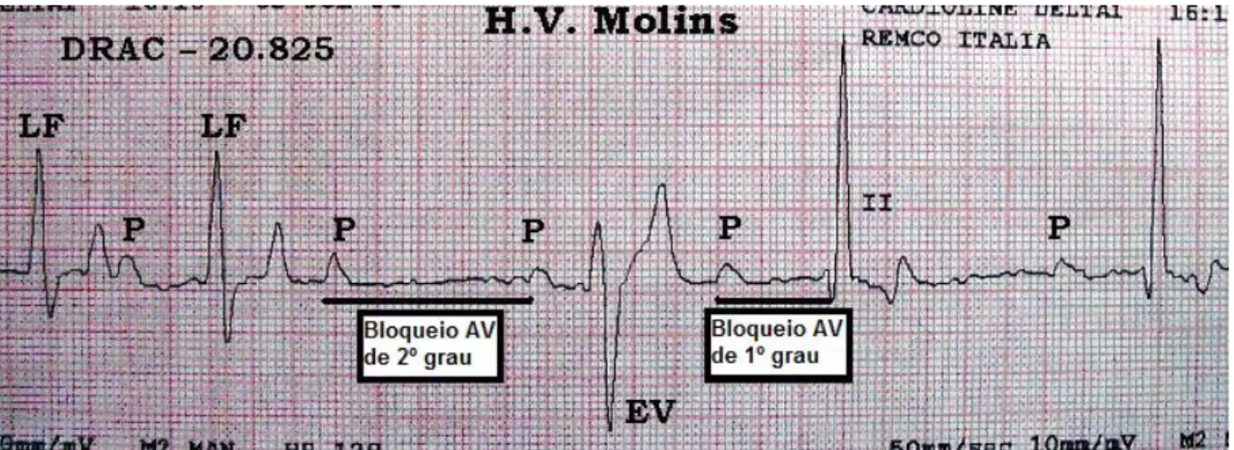 Figura  7  -  Electrocardiograma.  Presença  de  bloqueio  atrioventricular  de  2º  grau  e  de  bloqueio  atrioventricular  de  1º  grau