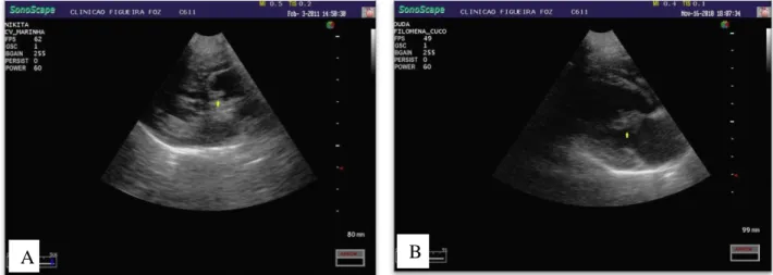 Figura  7.  (A)  Imagem  ecocardiográfica  de  um  cão  com  evidências  de  presença  de  vegetações na aorta, compatível com endocardite