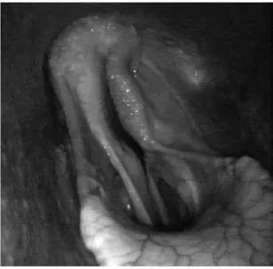 Figura 3 – Imagem endoscópica da laringe de um  cavalo em exercício com um grau IV de hemiplegia  laríngea