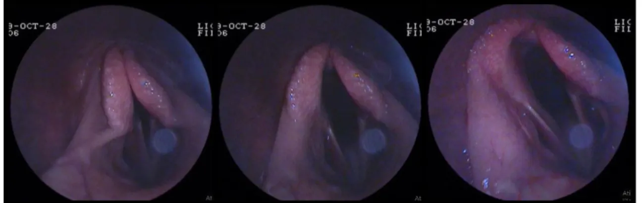 Figura  8  –  Sequência  de  imagens  endoscópicas  da  laringe  de  um  cavalo  com  hemiplegia  laríngea esquerda de grau III-3