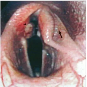 Figura  18  –  Condropatia  da  cartilagem  aritenoide esquerda e tecido de granulação  na  cartilagem  aritenoide  direita