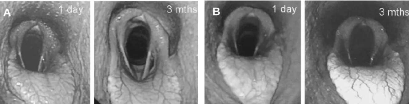 Figura 21  – Imagem endoscópica pós-cirúrgica de um cavalo após laringoplastia simples  (A) e após  laringoplastia e anquilose da articulação cricaritenóidea (B)