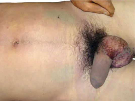 FIGURA  10  :  Mancha  verde  abdominal,  48  horas  após  o  óbito.  Em  detalhe  secreção  peniana