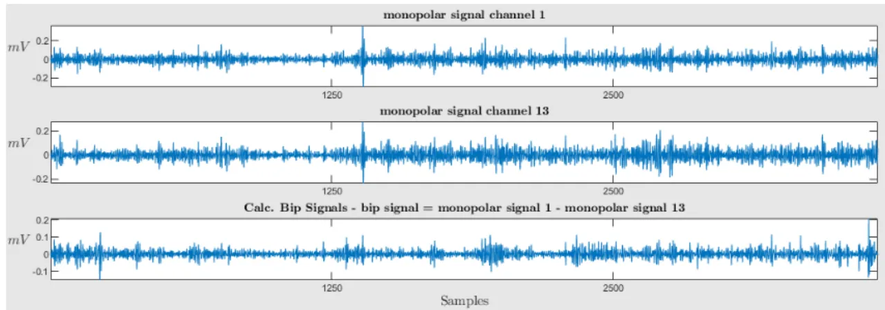 Figure 3.7: Effect of subtracting monopolar signals. The first two graphs represent records from different electrodes, while the third represents the bipolar signal resultant of the subtraction.