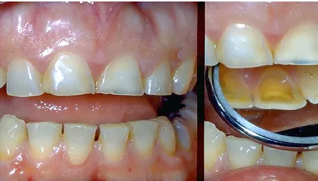 Figura 5 – Defeitos de desgaste dentário erosivo nas superfícies vestibulares e palatinas de dentes  anteriores (Vieira Carvalho, 2006) (Imagem gentilmente cedida pelo autor)