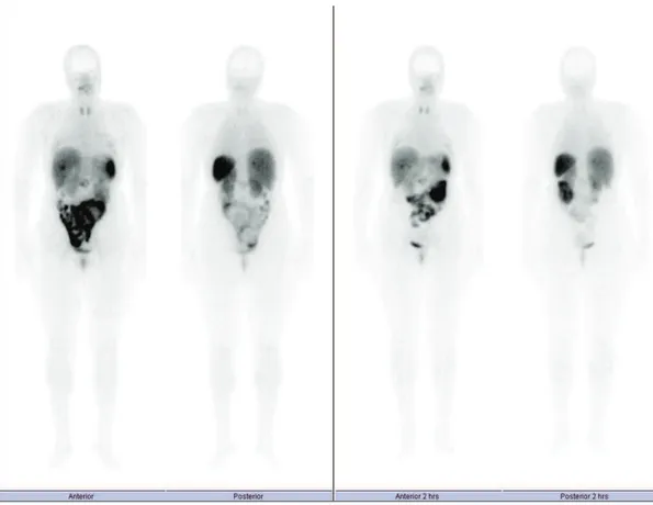 Figura 5- Varrimento de corpo inteiro às 2 e 4 horas com 99mTc-EDDA/ HYNIC-TOC. Imagem de seguimento