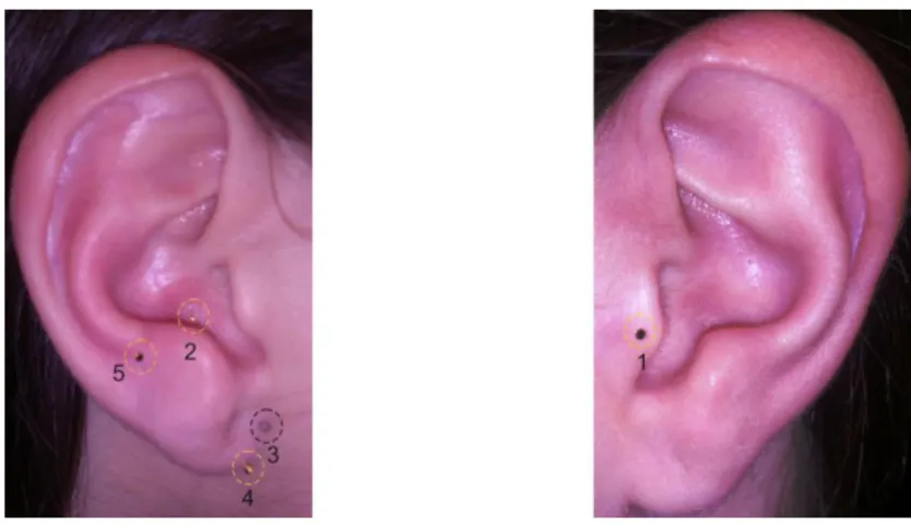 Figura 12 - Pontos auriculares comumente usados para tratamentos de ansiedade de acordo com o modelo  de  Heidelberg
