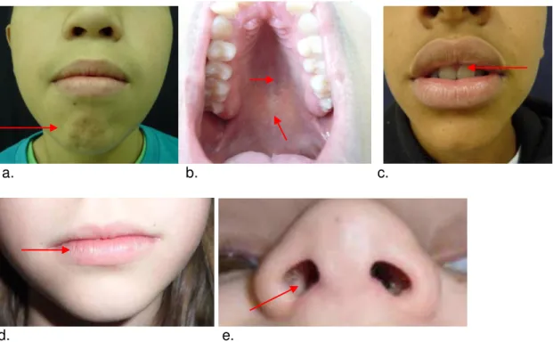 Figura 3 - Ilustração dos achados anatômicos e musculares mais frequentes no respirador oral: 