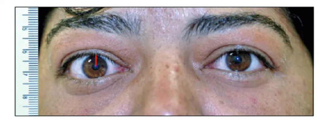 Figura 8 - Medida da distância da margem palpebral superior ao centro pupilar do olho direito, usando o programa  Image J