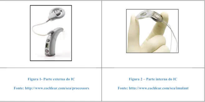 Figura 2 – Parte interna do IC   Fonte: http://www.cochlear.com/sea/implant Figura 1- Parte externa do IC  