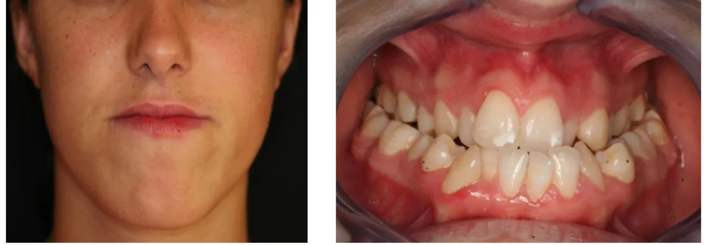 Figura 5 – Fotografias da face e de mordida frontal num paciente com deficiência maxilar transversal 