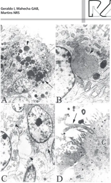 Figure 1 – Transmission Electron Microscopy (TEM). Efferent ductule epithelium ultra- ultra-estructural alterations of roosters affected by epididymal lithiasis.