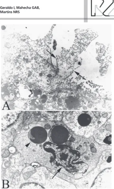 Figure 3 – Efferent ductules ultrastructural aspects of cellular vacuolation and other  alterations (TEM).