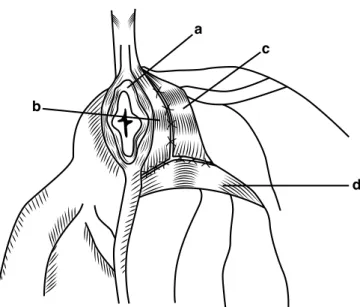 Figura 5 - Herniorrafia clássica (vista oblíqua) (adaptado de Gill 