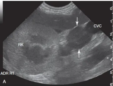 Figura  9-  Imagem  ecográfica,  em  eixo  transversal,  de  uma  massa  localizada  na  glândula  adrenal direita (setas) (Mattoon et al., 2015)