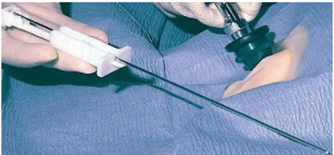 Figure 6. Manual Tru-Cut needle. (Watson 2014) 