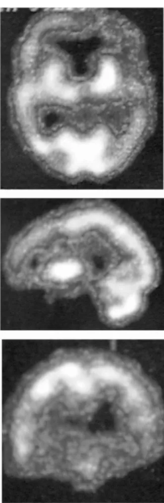 Figura 2. SPECT cerebral em um dos pacientes com DFT (LJ).