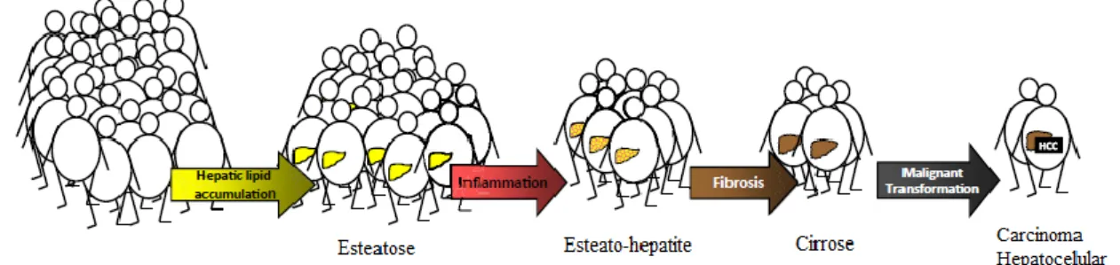 Figura 1- Evolução da EHNA. Adaptado de Dietrich et al. (2). A maioria dos indivíduos com obesidade  desenvolvem  EH  na  ausência  de  consumo  de  álcool