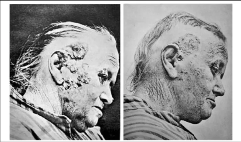 Figure 1.1 First documented patient treated with eosin and sunlight for skin lesions. Left picture  before, and right picture after the treatment [ 5 ]