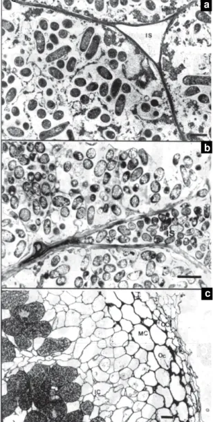 Figure 4. Transmission electron micrograph showing in- in-clusions of PBH and a rupture of peribacteroid membrane (PBM) of a nodule from cultivar EMGOPA-201 at five days of water stress (a); cultivar Carioca after eight days of water stress (b), showing ba