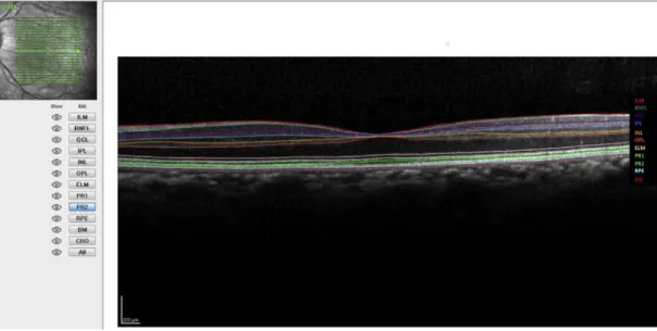 FIGURE 1. Retinal layer segmentation obtained with Spectralis automatic segmentation software.