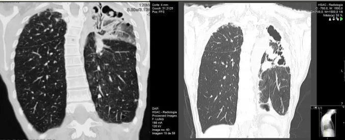 Figura  1.  À  esquerda:  Tomografia  computorizada  de  2015  demonstrando  a  destruição  parenquimatosa  apical  esquerda,  com  cavitações  e  espessamento  parenquimatoso