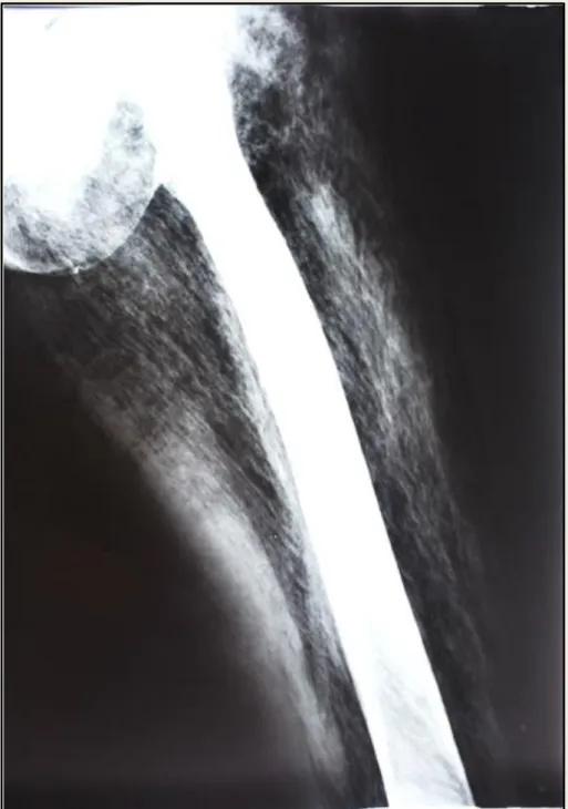 Figura 1: Dissecção muscular com presença de gás nos tecidos moles da coxa esquerda. 