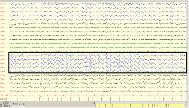 Figura  1:  Descargas  epiléticas  continuas  em  topografia  frontotemporal  direita  (em  evidência)  variando  entre 1,5-2,5 Hz compatível, pela associação com a clínica, com estado de mal epilético