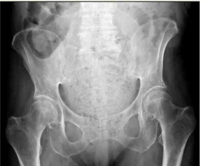 Figura 1 – Radiografia póstero-anterior do abdómen, constatando-se  volumosa massa abdominal 