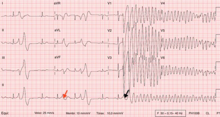 Figure 1 This 12-lead ECG recorded during a syncopal episode shows sinus rhythm with a heart rate of 83 bpm