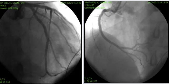 Figure 3 Coronary angiography of the left and right coronary circulation showed no signiﬁcant disease.