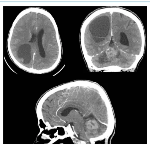 Figure 1. Preoperative CT scan. Axial, coronal and sagital gadolinium-enhanced.
