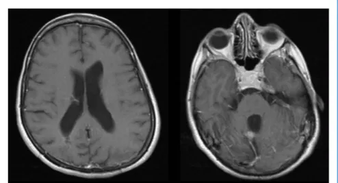 Figure 5. Postoperative MRI. Axial gadolinium-enhanced.