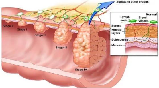 Figure 4. The colorectal cancer stages | Colorectal cancer can be classified in five stages