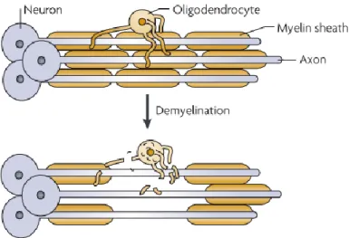 Figure I.3 - The demyelination of axons. This pathological process is characterized by the loss of myelin  sheaths around axons (Franklin and ffrench-Constant, 2008)