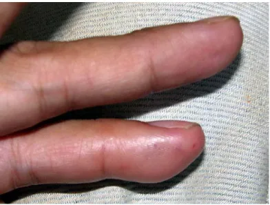 Figure 1: Beginning of swelling 12 min after the bite by Ithycyphus miniatus (Case 1)
