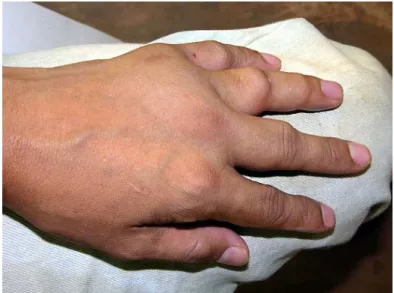 Figure 3: Maximum swelling of the left hand and fingers photographed 130 min after  the bite (Case 1)